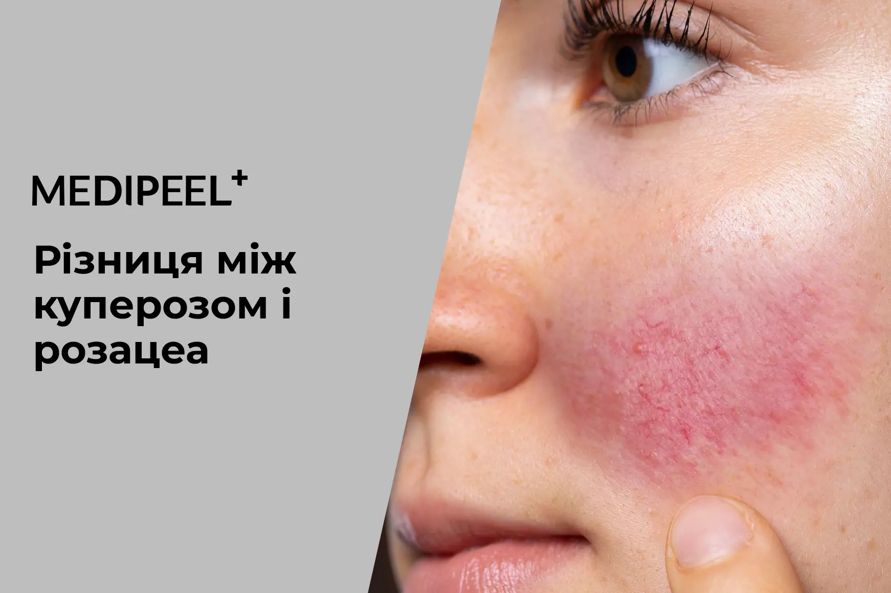 Різниця між куперозом і розацеа: основні симптоми та догляд