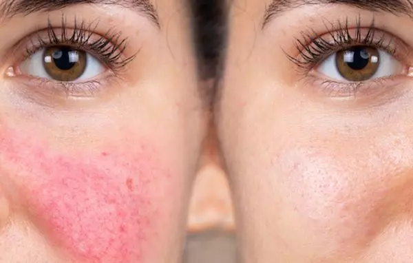 Купероз на лице