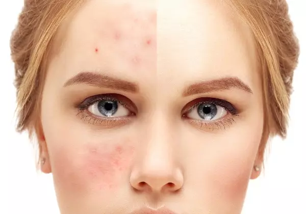 Купероз на лице