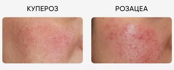 Різниця між куперозом і розацеа