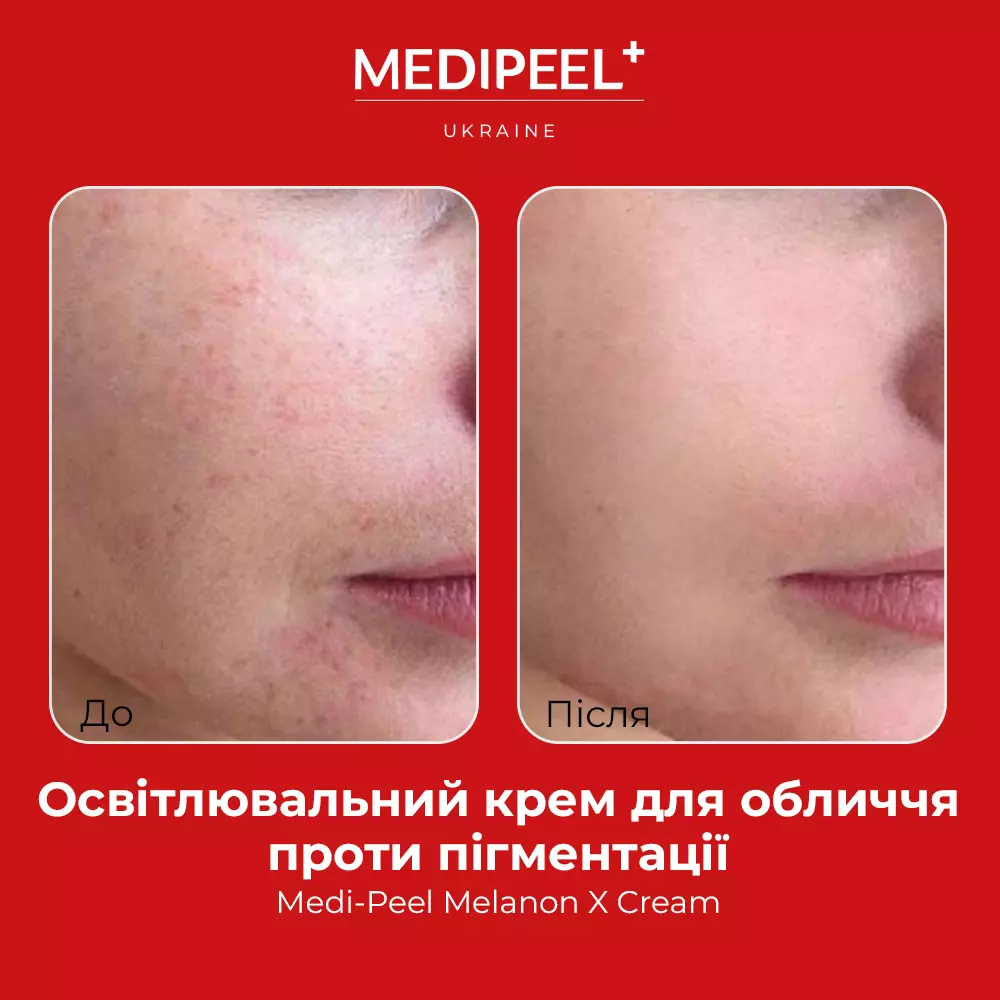 Кремы для лица из Кореи при пигментации и постакне | Haru Beauty