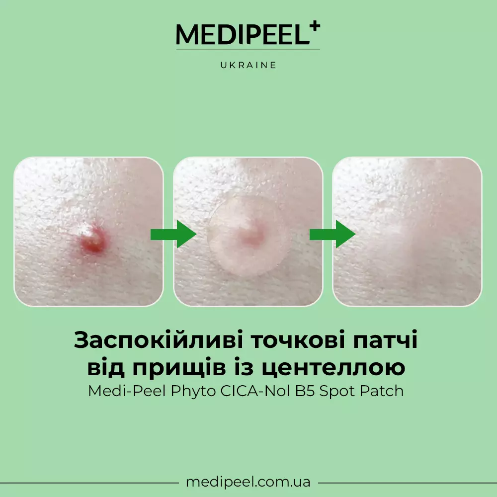 Патчи от прыщей