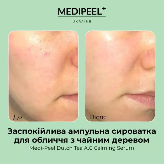 Medi-Peel Dutch Tea A.C Calming Serum