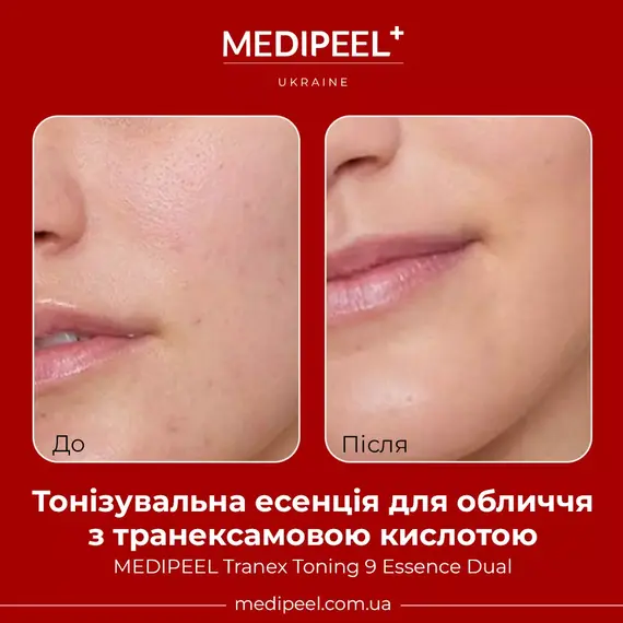 Tranex Toning 9 Essence Dual