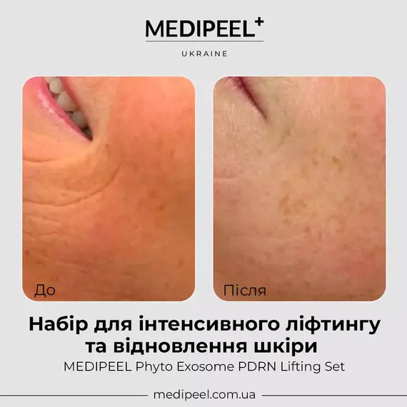 Phyto Exosome PDRN Lifting Set